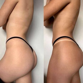 Opalanie natryskowe dla osób zmagających się z bielactwem?